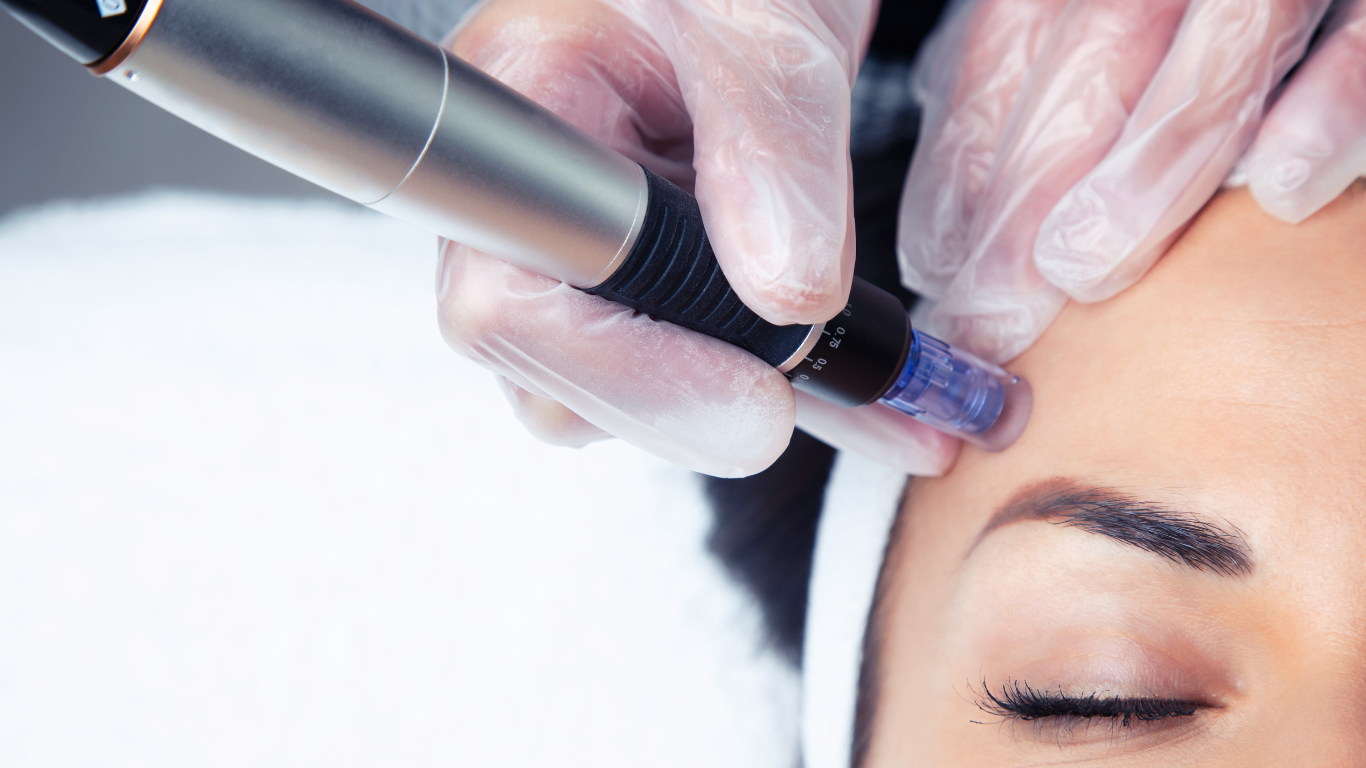 Micrneedling