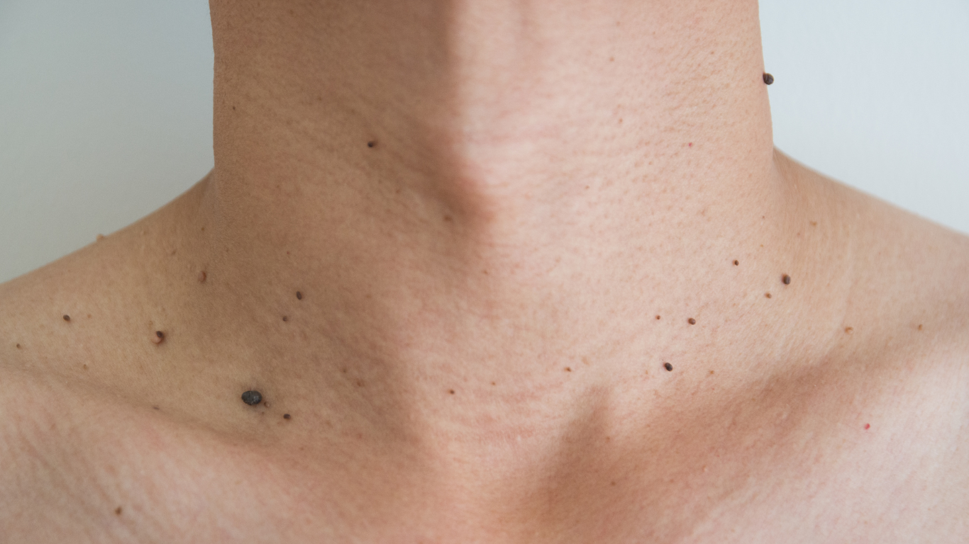 Skin Tag Removal Minneapolis St Paul Mn
