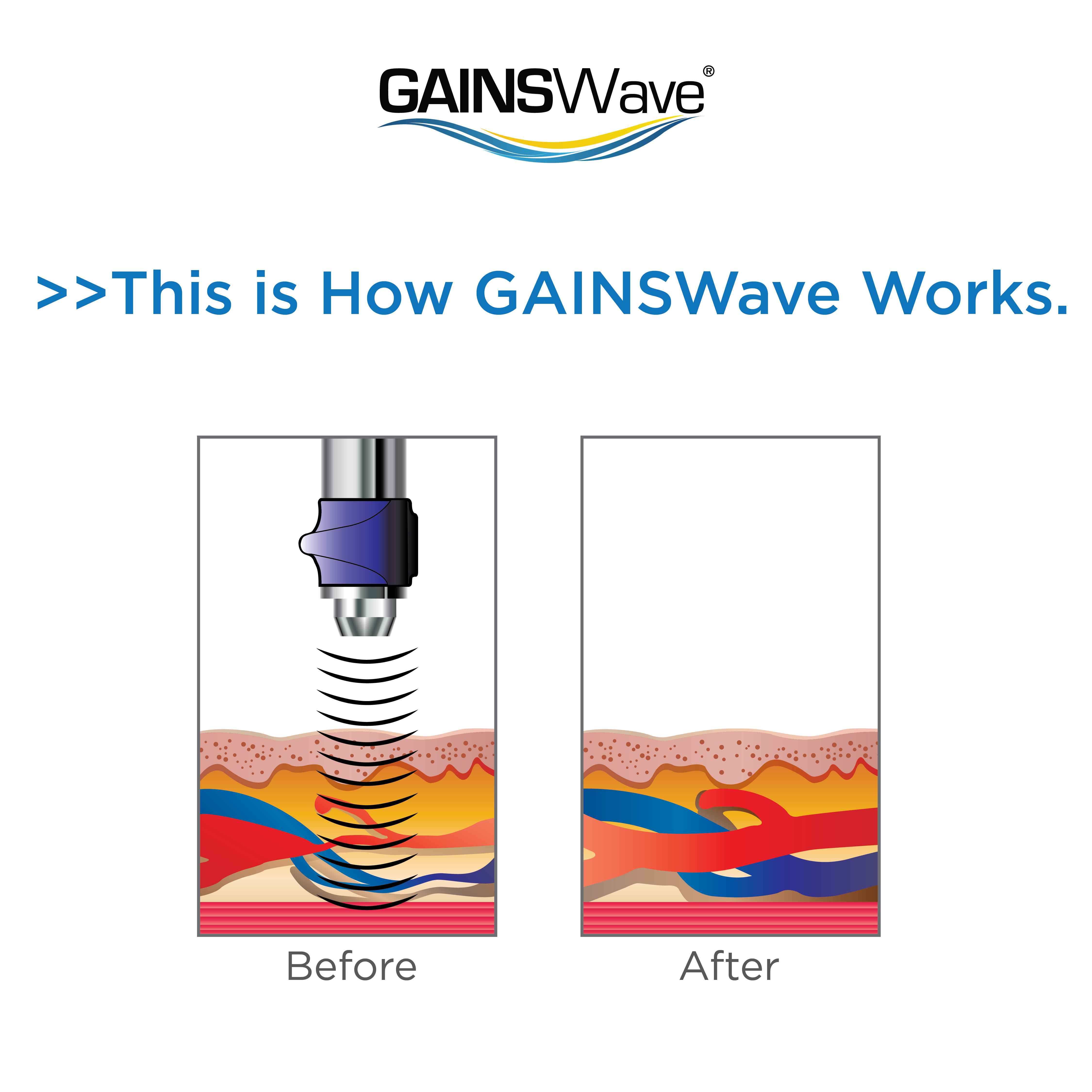 how GAINSWave works
